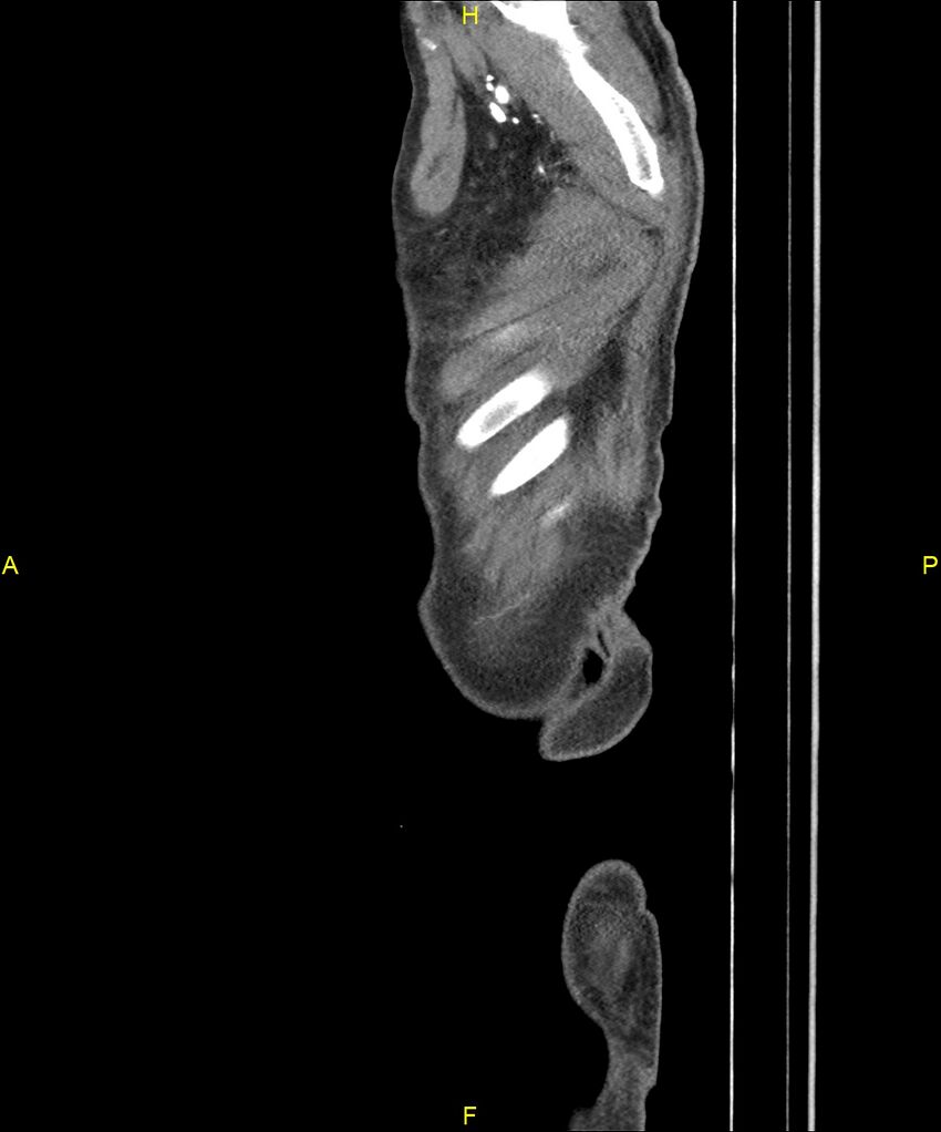 Aortoenteric fistula (Radiopaedia 84308-99603 C 332).jpg