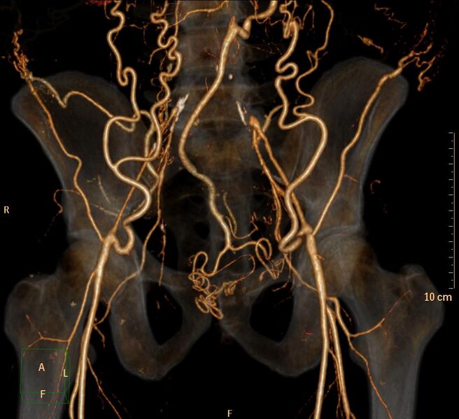 File:Aortoiliac occlusive disease (Radiopaedia 31376-32161 3D-VR-iliac arteries 1).jpg