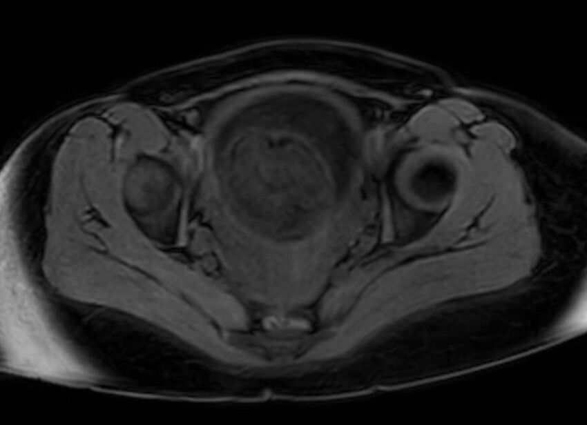 Appendicitis in gravida (MRI) (Radiopaedia 89433-106395 Axial DIXON 133).jpg