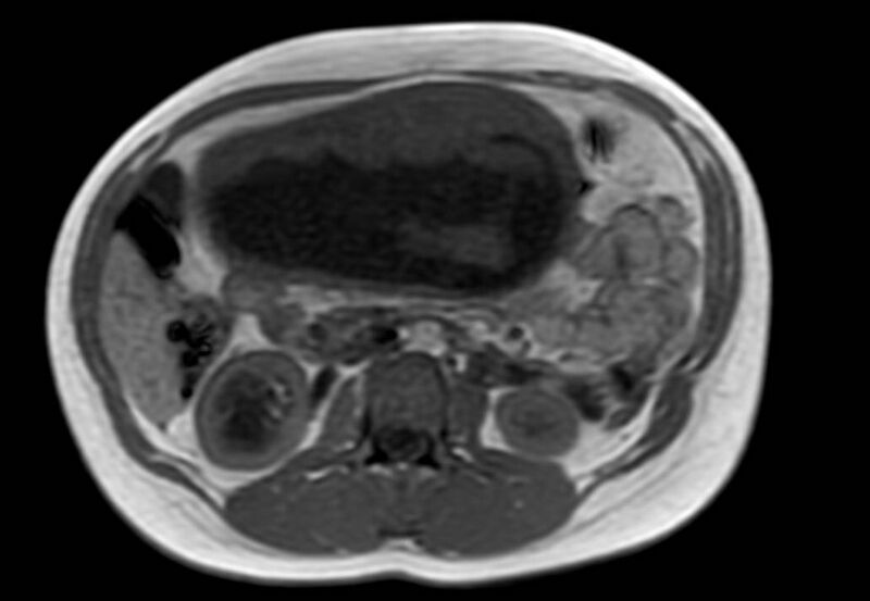File:Appendicitis in gravida (MRI) (Radiopaedia 89433-106395 Axial T1 in-phase 28).jpg