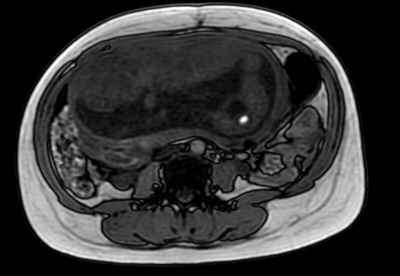 File:Appendicitis in gravida (MRI) (Radiopaedia 89433-106395 D 35).jpg