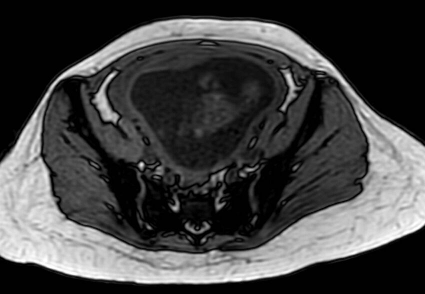 Appendicitis in gravida (MRI) (Radiopaedia 89433-106395 D 54).jpg