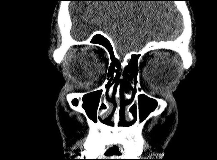 Arachnoid cyst- extremely large (Radiopaedia 68741-78450 Coronal bone window 60).jpg