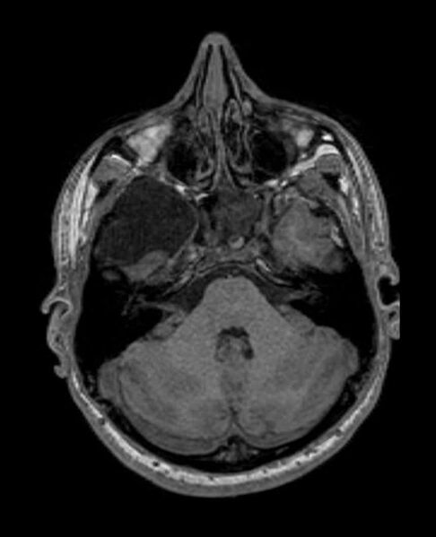 File:Arachnoid cyst- extremely large (Radiopaedia 68741-78451 Axial T1 20).jpg