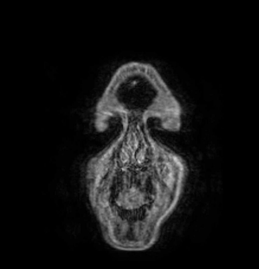 Arachnoid cyst- extremely large (Radiopaedia 68741-78451 Coronal T1 C+ 4).jpg