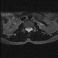 Arachnoid cyst - spinal (Radiopaedia 66835-76157 Axial T2 10).jpg