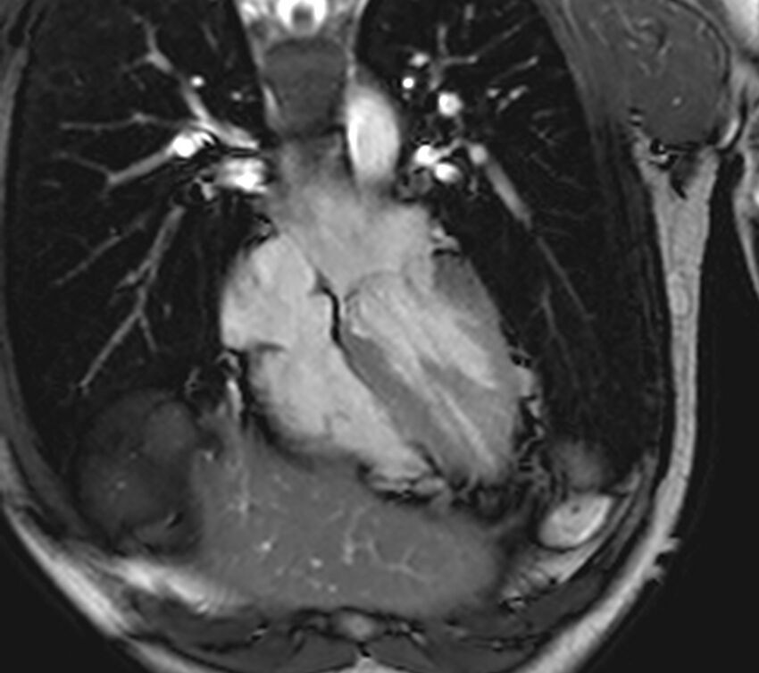 Arrhythmogenic right ventricular cardiomyopathy (Radiopaedia 39806-42237 D 112).jpg