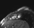 Arrhythmogenic right ventricular cardiomyopathy (Radiopaedia 69564-79464 short axis cine 15).jpg