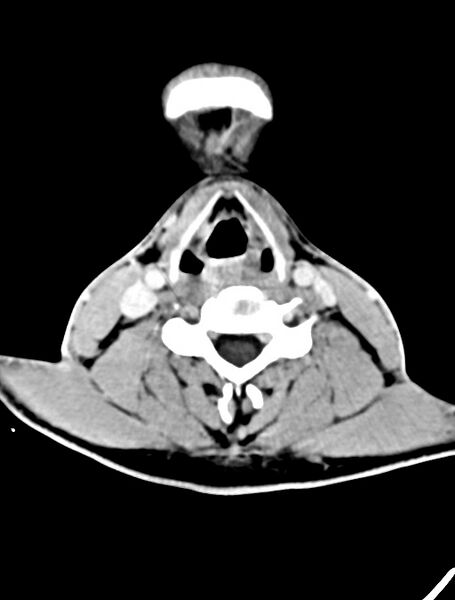 File:Arrow injury to the face (Radiopaedia 73267-84011 Axial C+ delayed 7).jpg