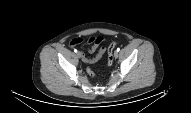 File:Arterial occlusive mesenteric ischemia (Radiopaedia 84641-100060 A 111).jpg