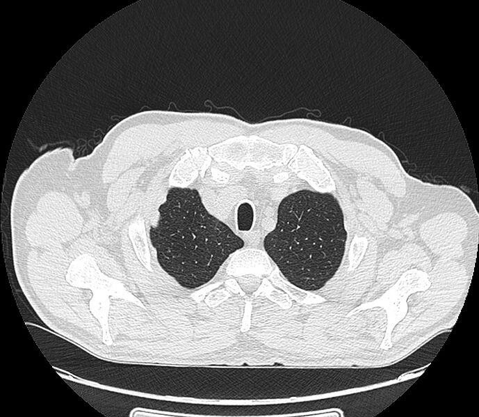 File:Asbestos pleural placques (Radiopaedia 57905-64872 Axial lung window 40).jpg