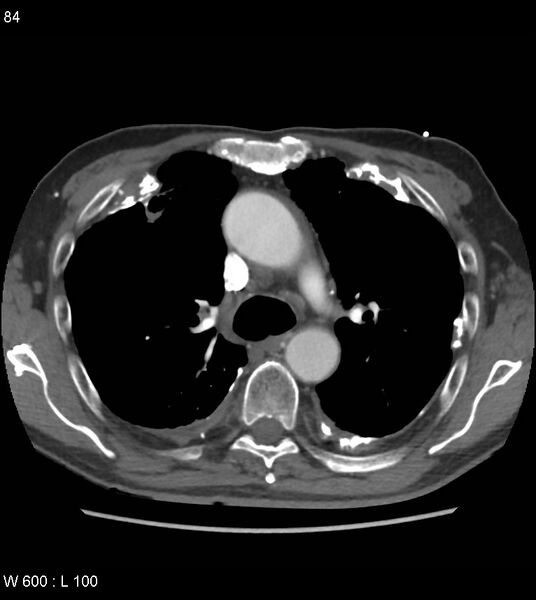 File:Asbestos related lung and pleural disease (Radiopaedia 14377-14301 D 20).jpg