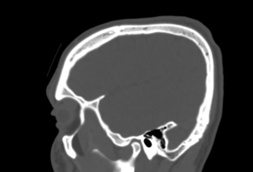 Asymptomatic occipital spur (Radiopaedia 87753-104201 Sagittal bone window 50).jpg