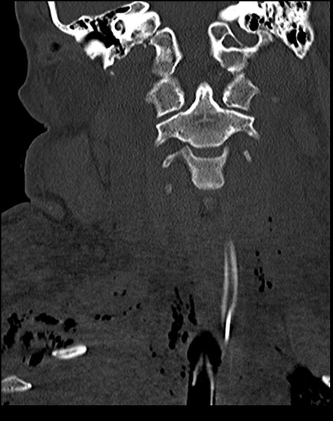 File:Atlanto-occipital dissociation - Traynelis type 1 (Radiopaedia 87570-103948 Coronal bone window 27).jpg