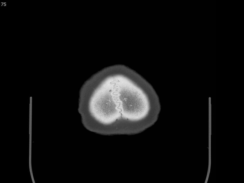 Atypical meningioma - intraosseous (Radiopaedia 64915-73867 Axial C+ bone window 75).jpg