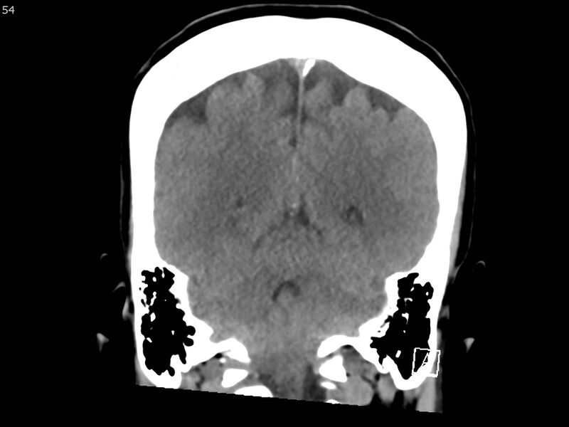 File:Atypical meningioma - intraosseous (Radiopaedia 64915-73867 B 53).jpg