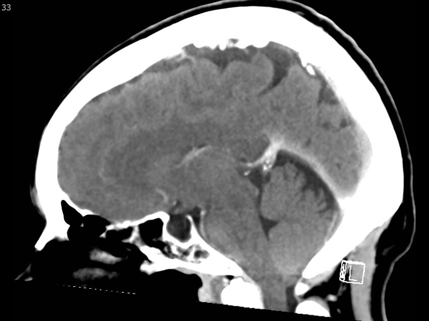 Atypical meningioma - intraosseous (Radiopaedia 64915-73867 F 32).jpg