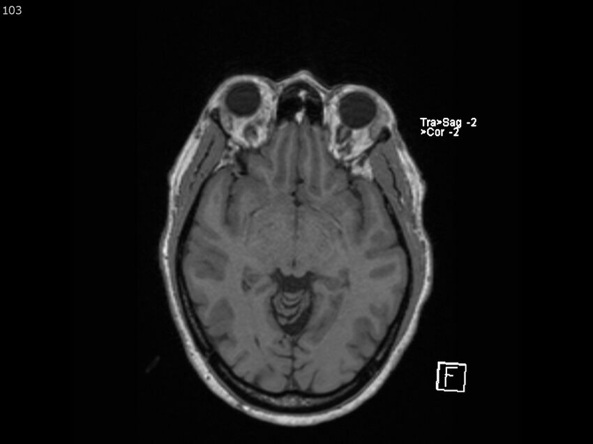 Atypical meningioma - intraosseous (Radiopaedia 64915-74572 Axial T1 103).jpg
