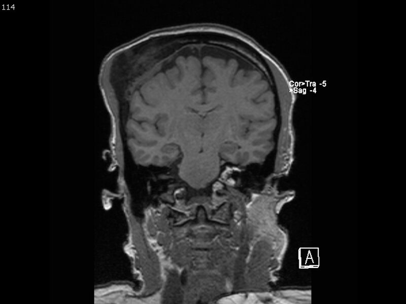 File:Atypical meningioma - intraosseous (Radiopaedia 64915-74572 Coronal T1 114).jpg