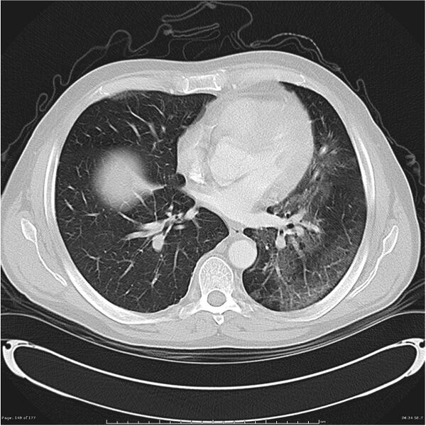 File:Atypical pneumonia - Q fever (Radiopaedia 21993-21989 lung window 27).jpg