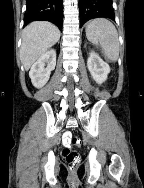 File:Autoimmune pancreatitis (Radiopaedia 84925-100431 D 46).jpg