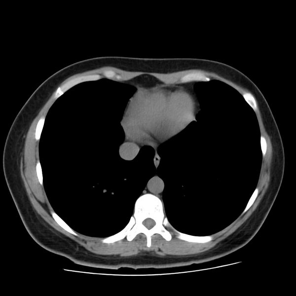File:Autosomal dominant polycystic kidney disease (Radiopaedia 23061-23093 Axial non-contrast 2).jpg