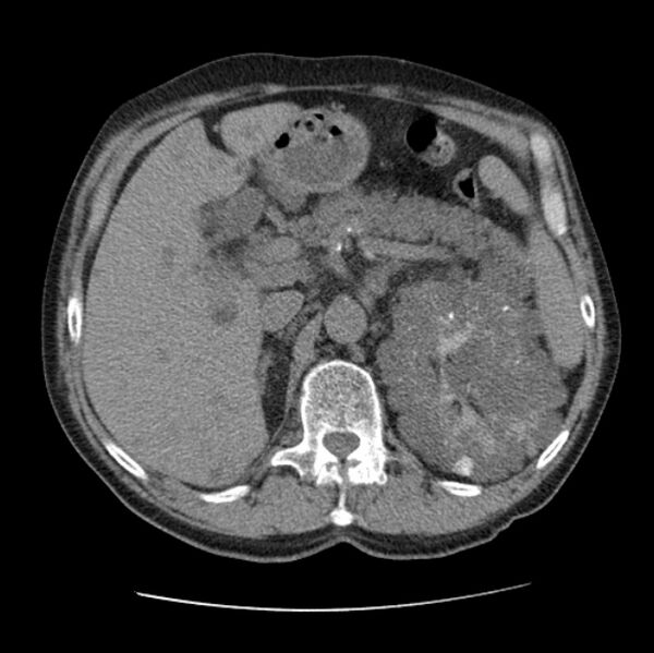 File:Autosomal dominant polycystic kidney disease (Radiopaedia 27851-28094 Axial non-contrast 60).jpg