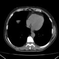 Autosomal dominant polycystic kidney disease (Radiopaedia 36539-38101 Axial non-contrast 3).jpg