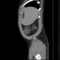 Autosomal dominant polycystic kidney disease (Radiopaedia 36539-38101 D 10).jpg