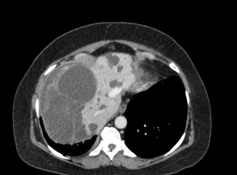 File:Autosomal dominant polycystic kidney disease (Radiopaedia 57124-64017 A 21).jpg