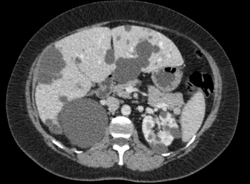 File:Autosomal dominant polycystic kidney disease (Radiopaedia 57124-64017 A 47).jpg