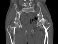 Avascular necrosis of the left hip (Radiopaedia 75068-86125 Coronal bone window 40).jpg
