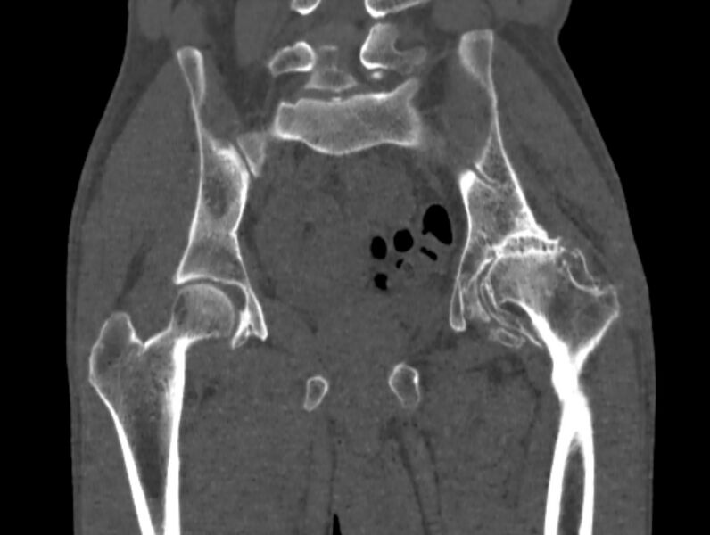 File:Avascular necrosis of the left hip (Radiopaedia 75068-86125 Coronal bone window 40).jpg