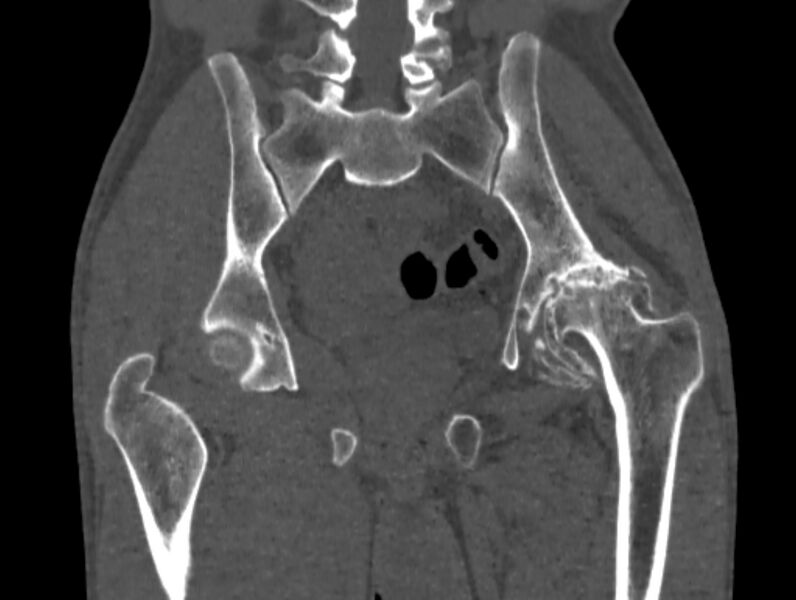 File:Avascular necrosis of the left hip (Radiopaedia 75068-86125 Coronal bone window 49).jpg