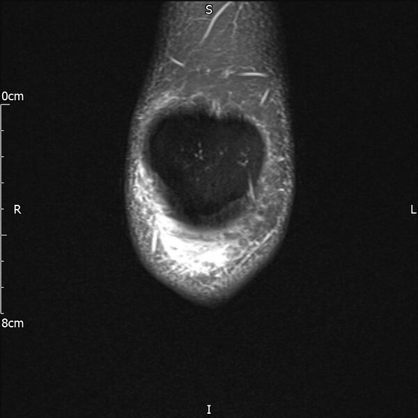 File:Avulsion fracture of the fibular head (Radiopaedia 74804-85808 Coronal PD fat sat 5).jpg