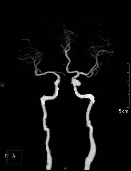 File:Azygos anterior cerebral artery (Radiopaedia 30805-31512 3D 1).jpg