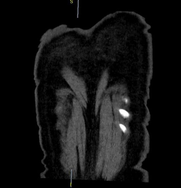File:Azygos vein aneurysm (Radiopaedia 77824-90130 C 30).JPG