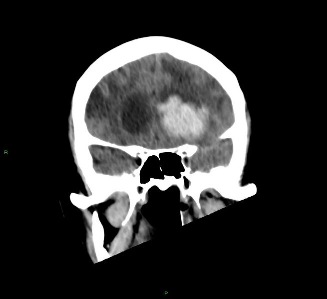 File:Basal ganglia hemorrhage (Radiopaedia 58766-65988 Coronal non-contrast 46).jpg