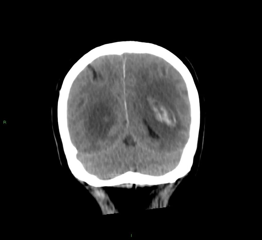 Basal ganglia hemorrhage (Radiopaedia 58775-66008 Coronal non-contrast 17).jpg