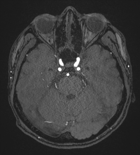 File:Basal ganglia subacute infarct (Radiopaedia 80201-93521 Axial MRA 34).png