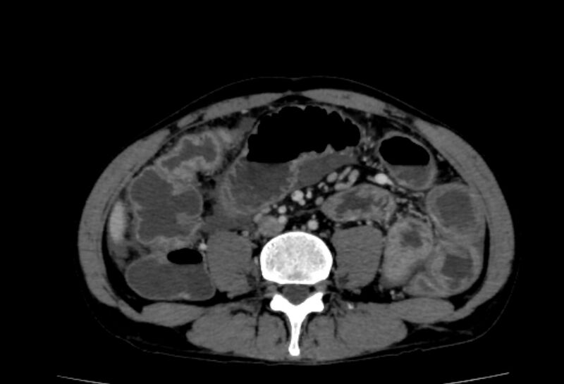 File:Behçet's disease- abdominal vasculitis (Radiopaedia 55955-62570 A 48).jpg
