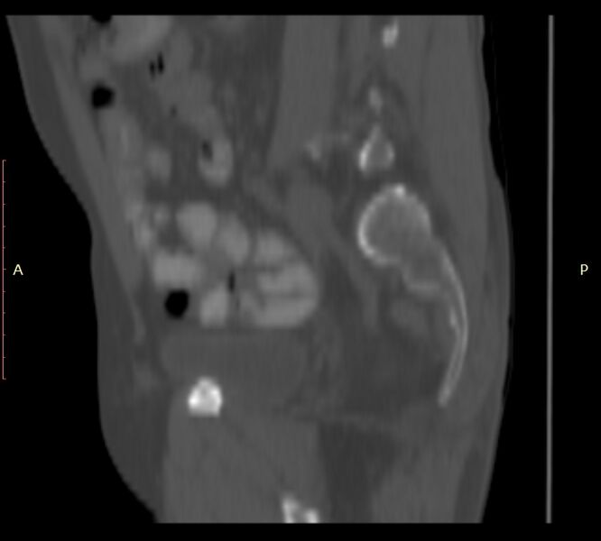 File:Bertolotti syndrome (Radiopaedia 58974-66235 Sagittal bone window 8).jpg