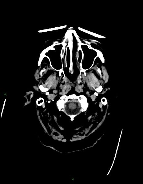 File:Bilateral acute middle cerebral artery territory infarcts (Radiopaedia 77319-89401 Axial non-contrast 3).jpg