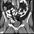 Bilateral direct inguinal herniae (Radiopaedia 17016-16719 A 17).jpg