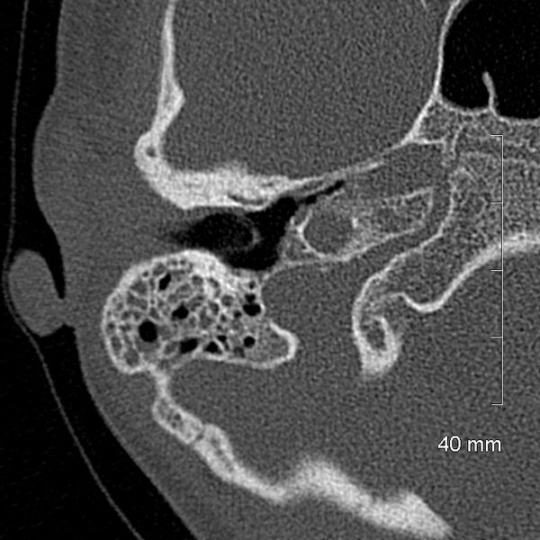 File:Bilateral grommets (Radiopaedia 47710-52404 Axial bone window 27).jpg