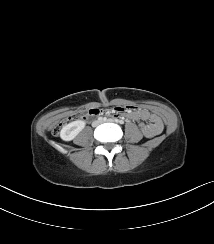 Bilateral kidney malrotation (Radiopaedia 72227-82749 A 43).jpg