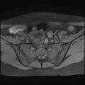 Bilateral ovarian endometriomas (Radiopaedia 87085-103347 Axial T1 fat sat 4).jpg