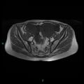 Bilateral ovarian fibroma (Radiopaedia 44568-48293 Axial T1 10).jpg