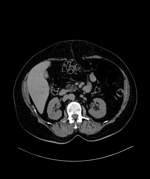 File:Bilateral sporadic synchronous clear cell renal cell carcinoma (Radiopaedia 85035-100572 Axial non-contrast 28).jpg