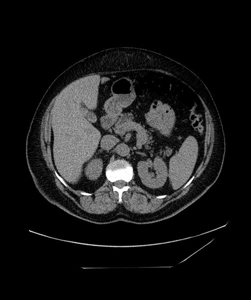 File:Bilateral sporadic synchronous clear cell renal cell carcinoma (Radiopaedia 85035-100573 Axial non-contrast 46).jpg